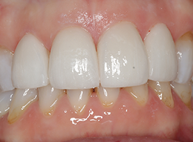 After Treatment